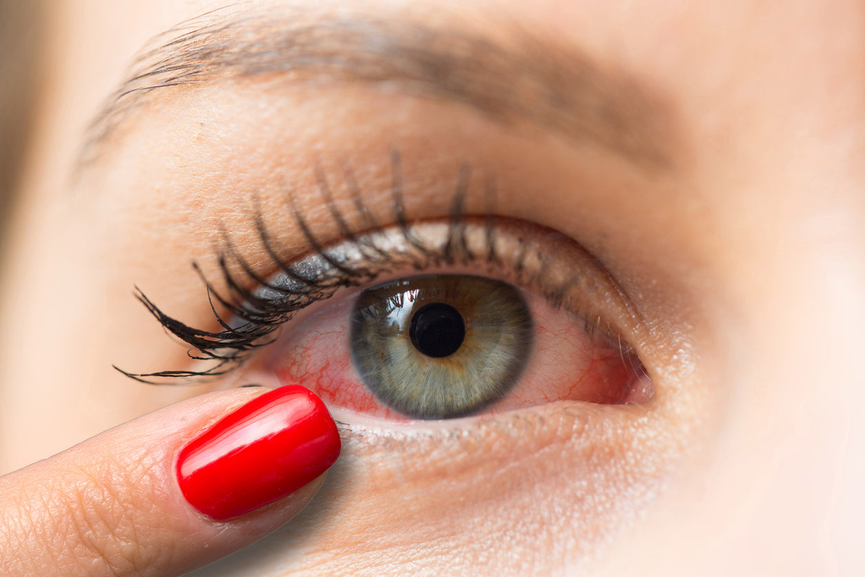 close up of dry, sore eyes